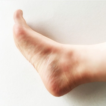 Oさま　（10代・男性）　症状：両足かかとの痛み